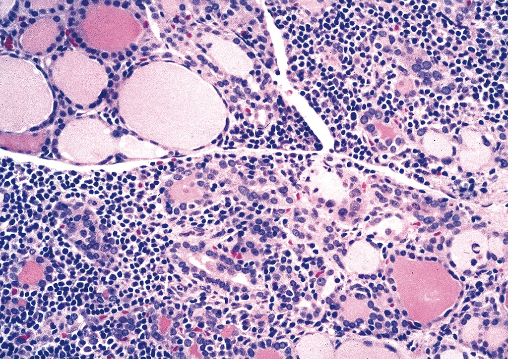 Pathology Outlines Hashimoto Thyroiditis 8737